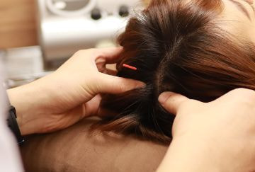 山本式新頭鍼治療